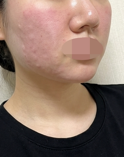 지인 피부 보고 바로 따라한 포텐자, 수면 김에 리쥬란까지 같이 받았어요~
