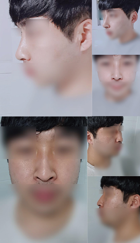 미용코+콧볼축소 후기