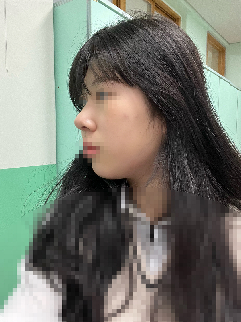 황원장님께 수술 받은지 한달차입니다!