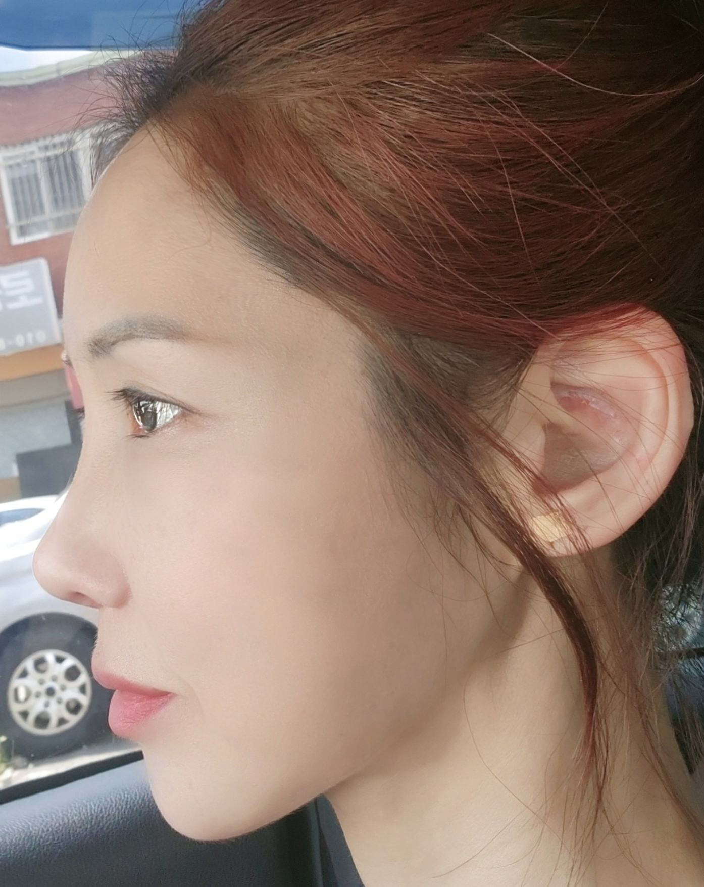 코막힘 심하고 코끝도 신경쓰여 서울아이에서 코 재수술 받은지 2주차에용