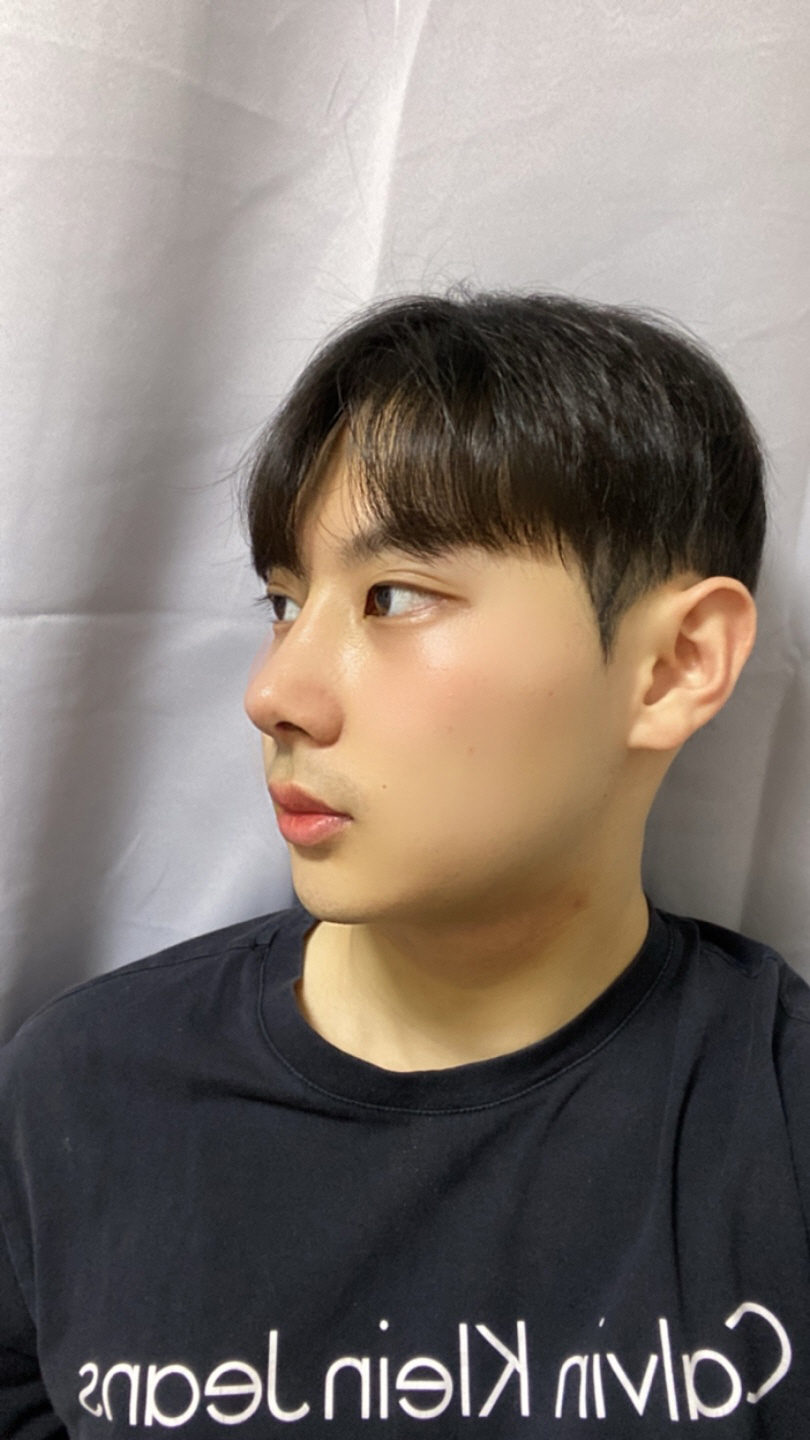 1주차 보다 붓기가 빠지면서 훨씬 자연스러워져서 더욱 만족하고 있습니다
