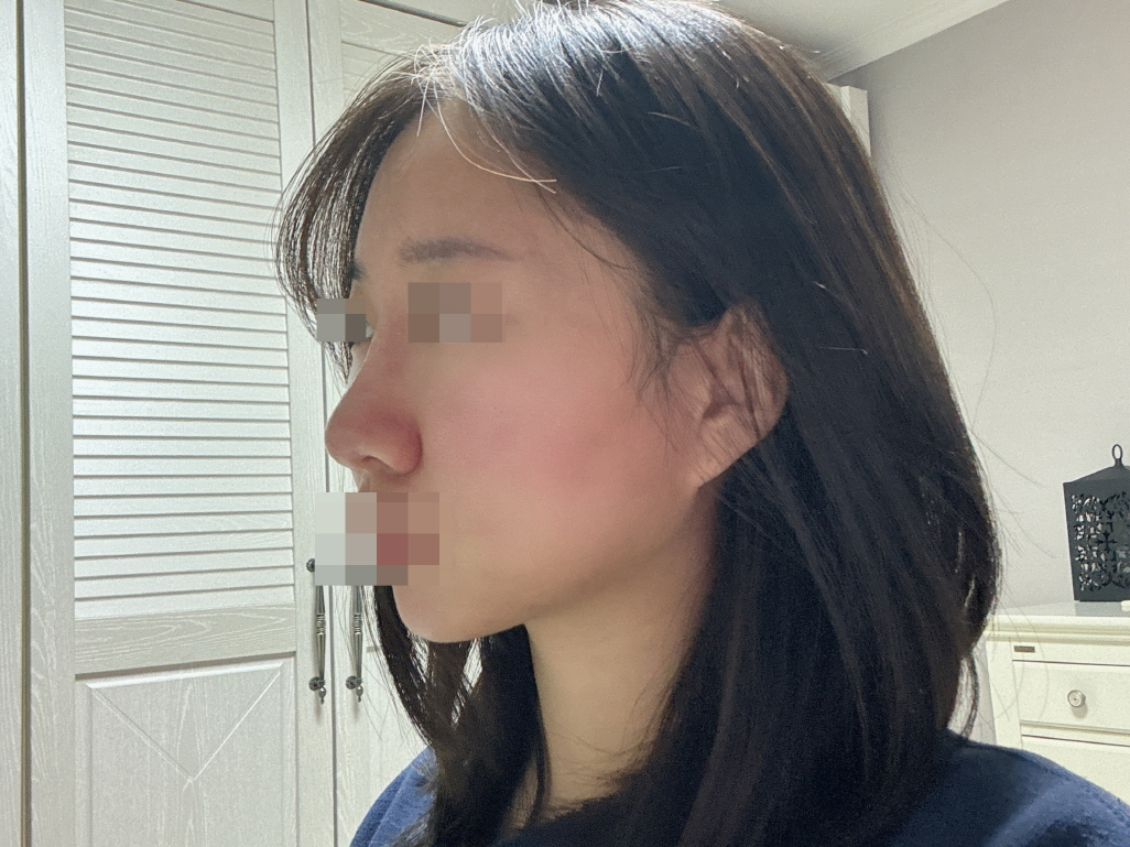 수술 했다고 이야기 안 하면 아무도 모르고 원래 예쁜 코였던 걸로 알아요 ㅎㅎ