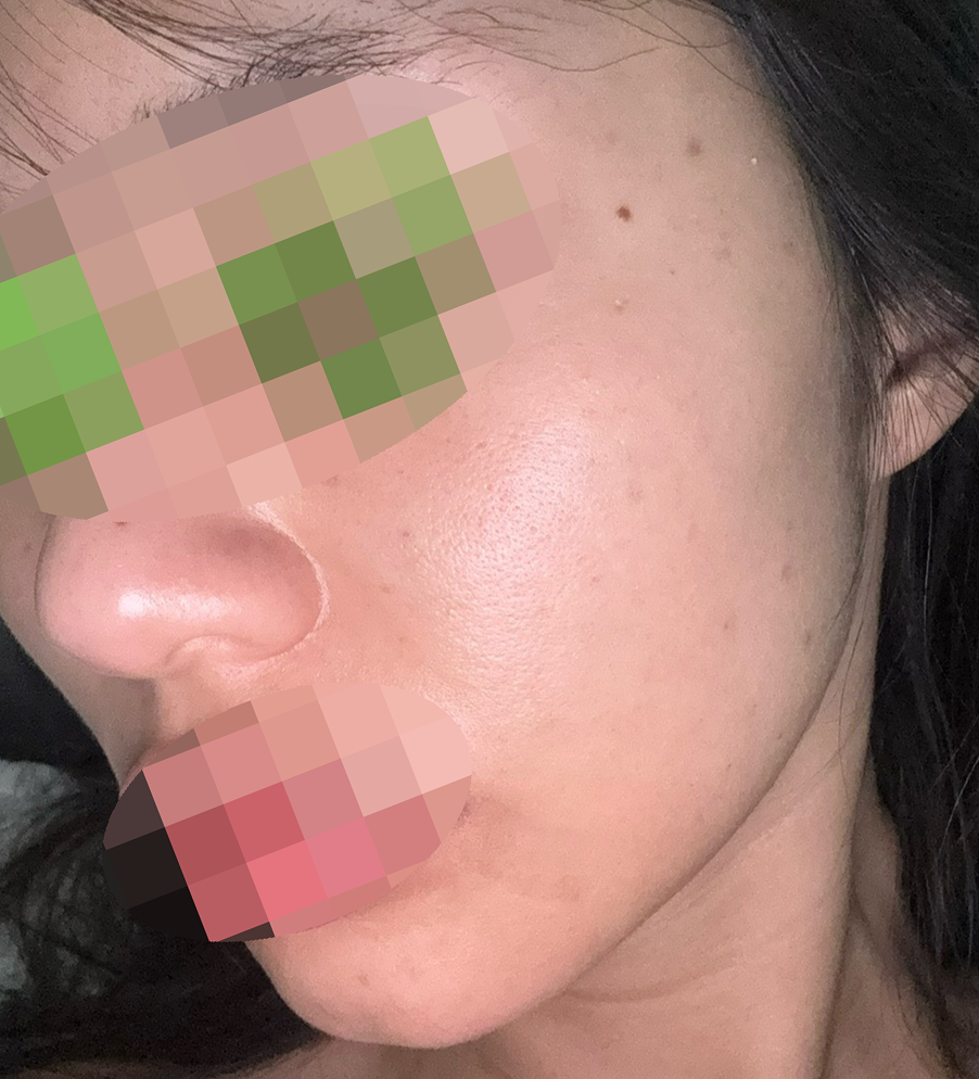 얼굴 칙칙해서 리쥬란힐러 받았는데 괜찮은 것 같아요 ㅎㅎ