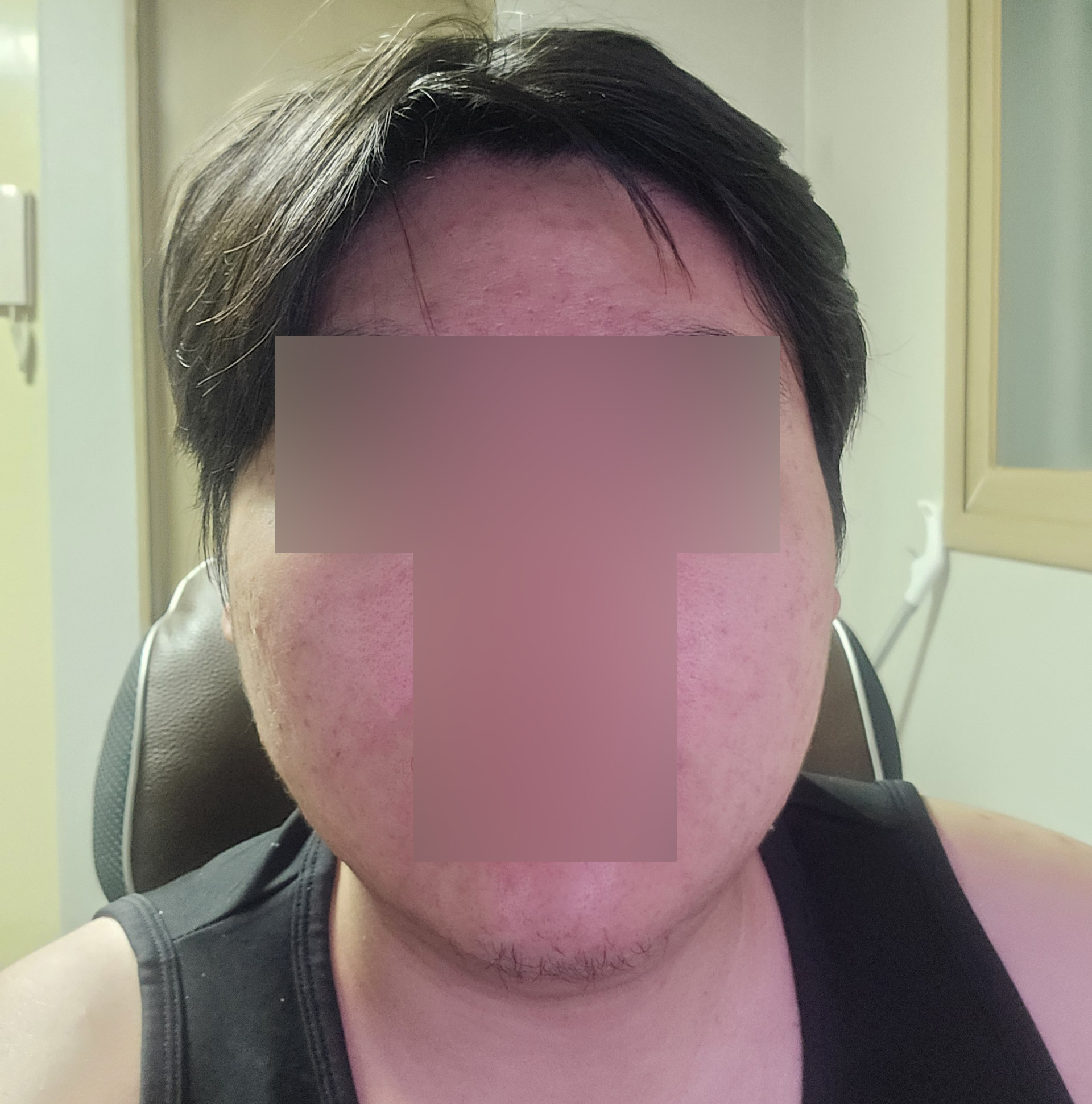 이중턱·턱선 지방흡입 1달차, 기대되는 경과 변화