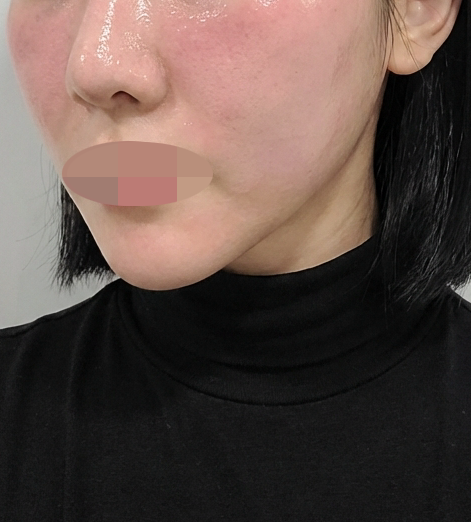 화장이 예전처럼 안 먹히더니 엑소좀으로 다시 진행했어!