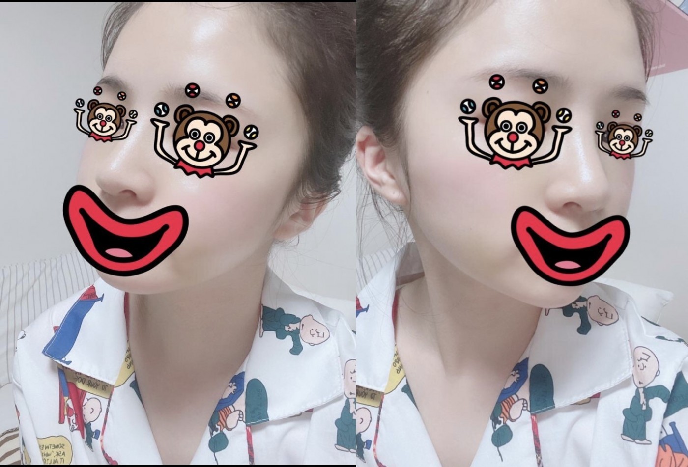 코수술 후기