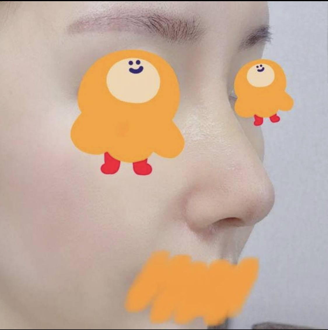 매부리인 구해주셔서 감사합니다!! 원장님~