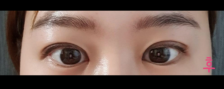 눈 재수술