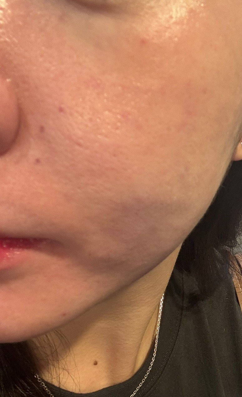 눈밑 잔주름이랑 모공, 홍조 고민으로 아이리쥬란 처음 받아봤어요