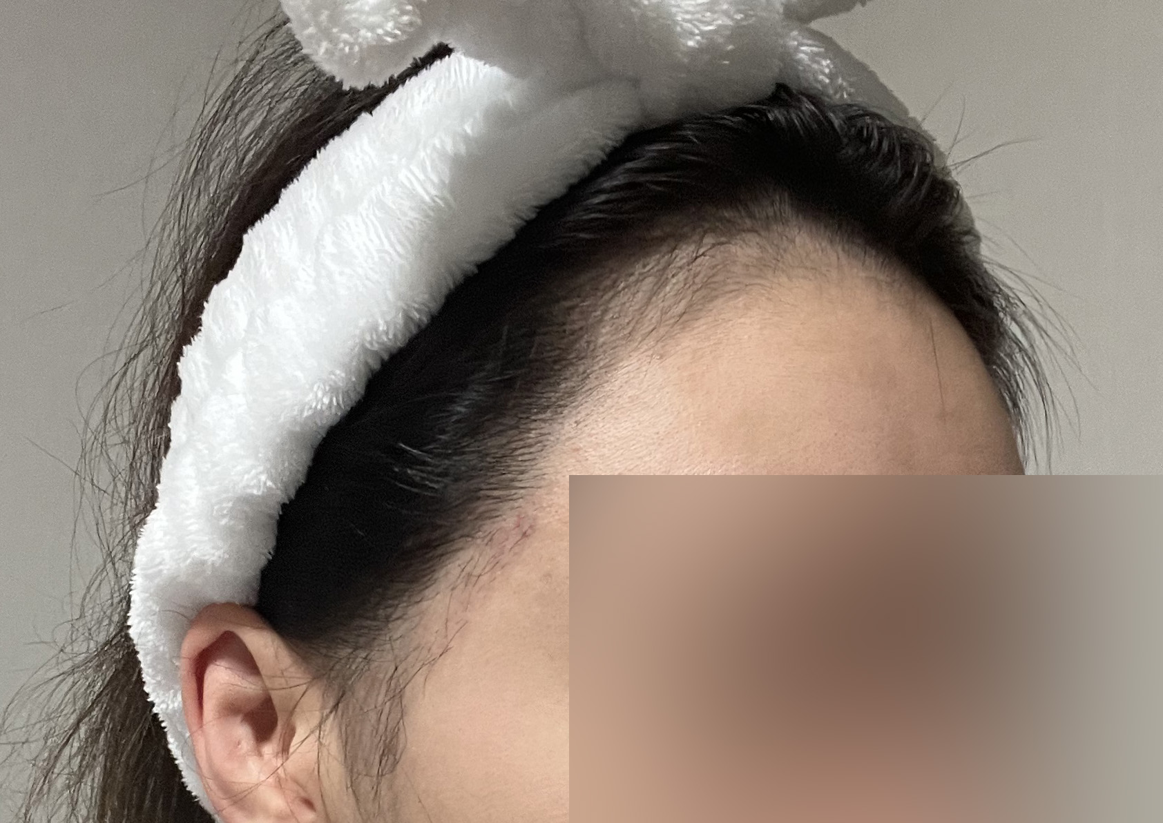 비절개 비삭발 모발이식 1달차, 암흑기 지나며 경과 지켜보는 중입니당~