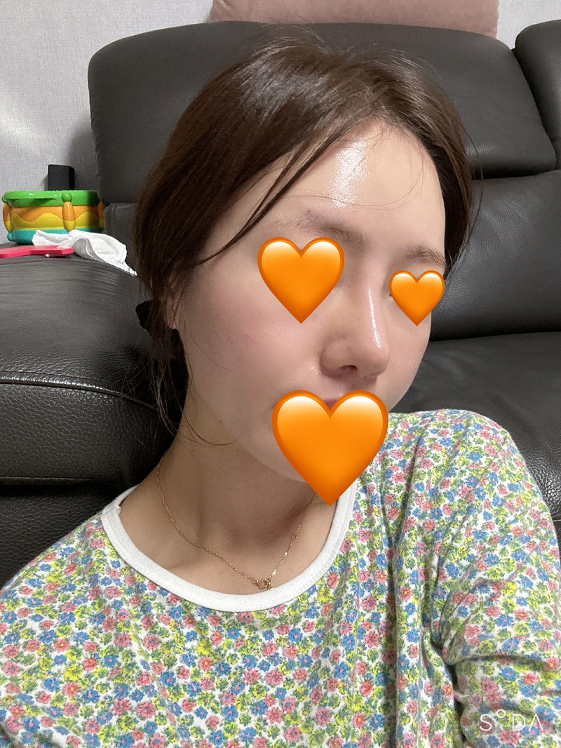 아직 2주차인데도 코가 많이 날렵해지고 붓기빠지는게 하루하루 달라요 앞으로가 더더 기대됩니다 ᅮ