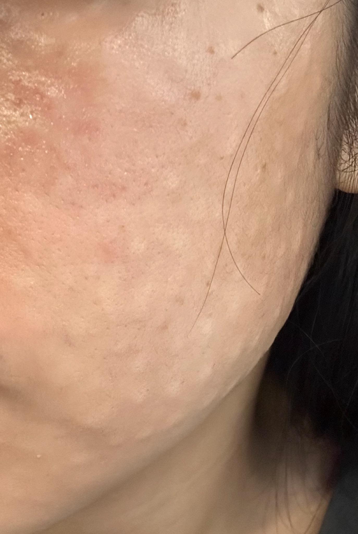 엠보 촘촘하게 올라온 거 보니 효과 기대돼요~!