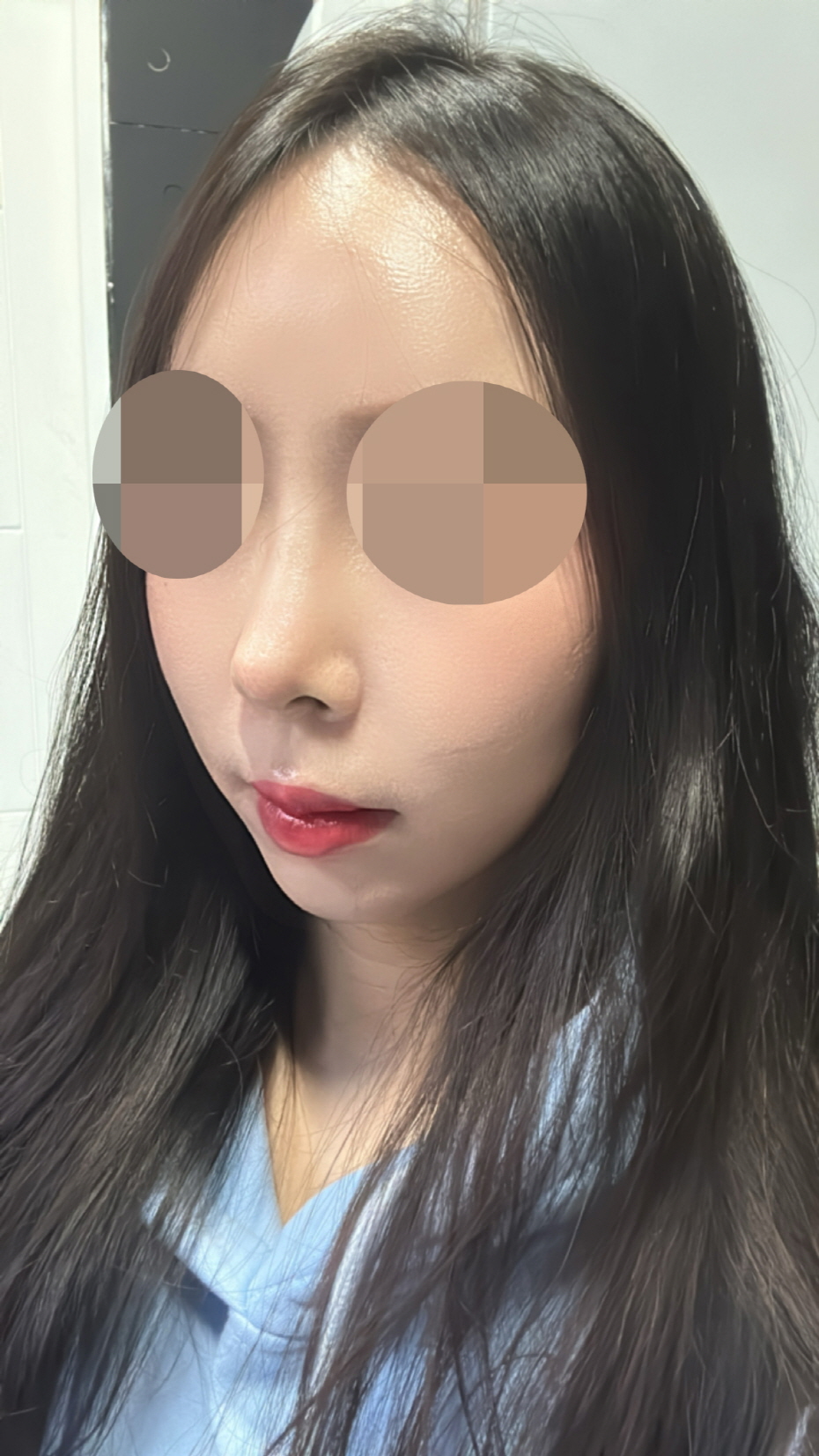수술 1개월차 후기입니다 :)