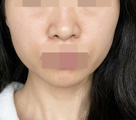 붓기 5일 차부터 빠지기 시작, 10일이면 깔끔하게 정리돼요!