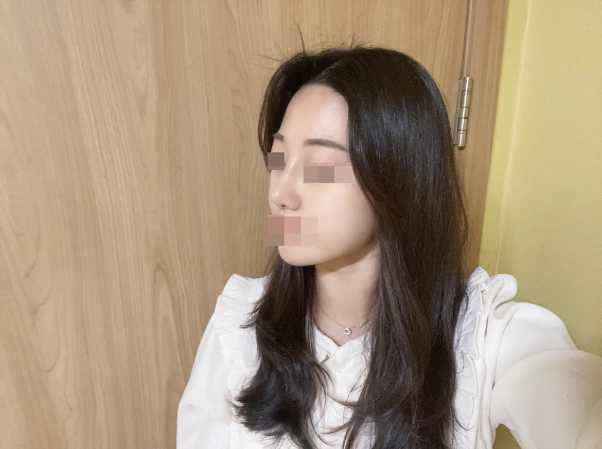 자연스럽게 코끝이 올라갔고 매부리코가 개선되고 너무 만족스럽습니다.