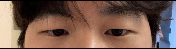 남자 눈성형 ㅎㅎ