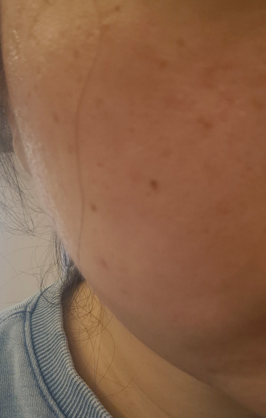 모공 때문에 찾아봤는데 포텐자가 제일 좋다길래 바로 예약했어요