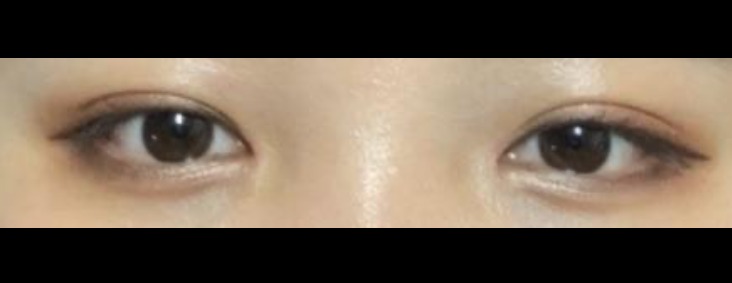 앞트임/눈매교정/쌍꺼풀매몰 수술 후기