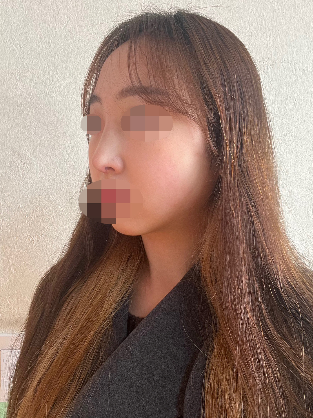 2주차 많이 자연스럽고 실밥도 안팎으로 다 제거했습니다.