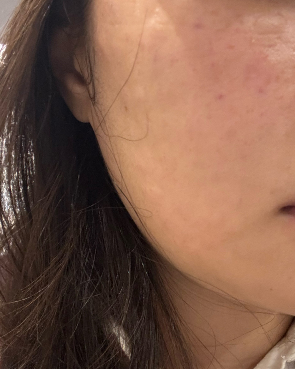리쥬란 받아봤는데 친절하고 잘 해주셔서 경과가 기대돼요