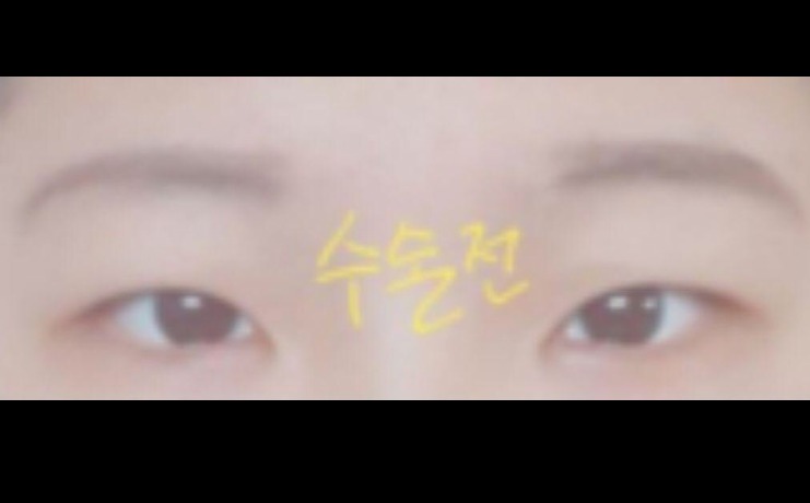 쌍꺼풀, 앞트임, 눈매교정