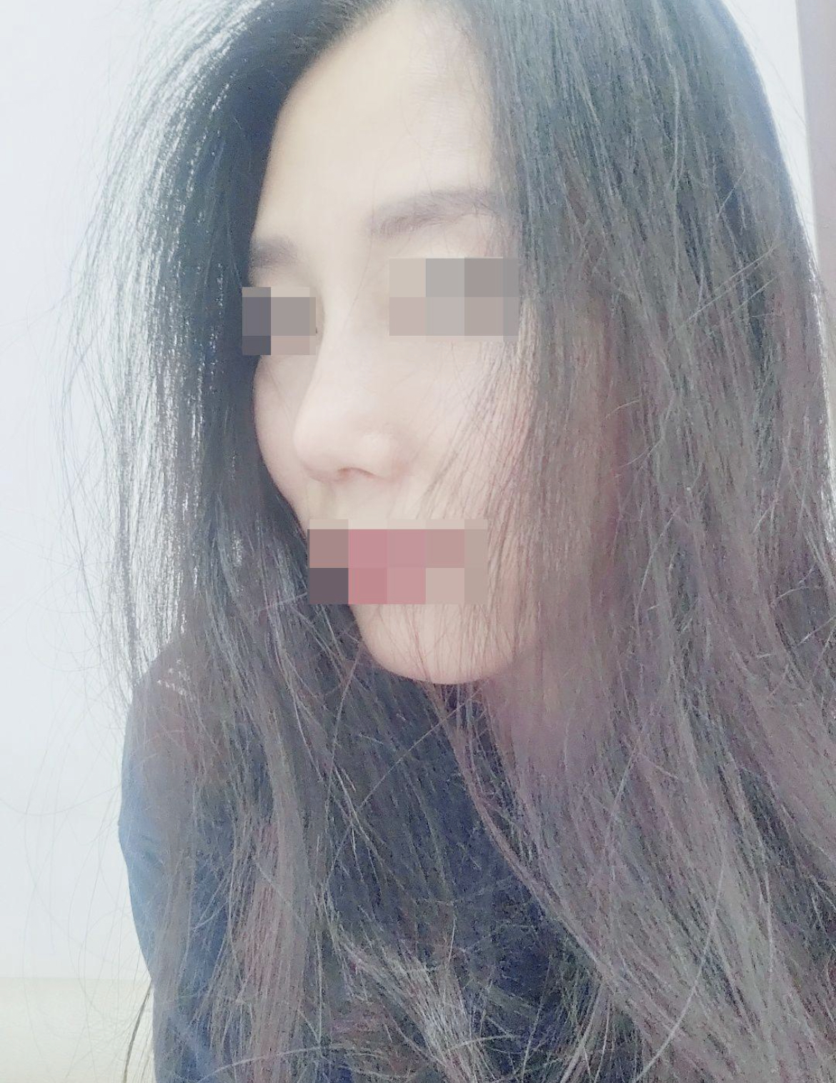 서울아이성형외과에서 코수술 받은지 한달째입니다