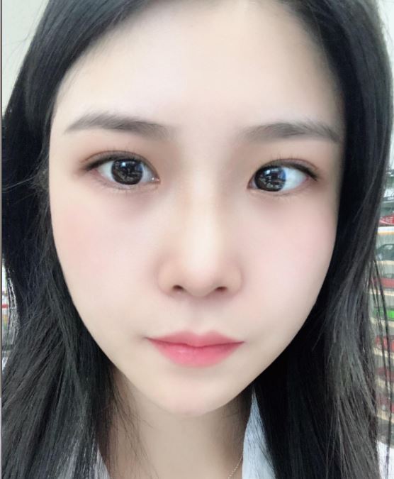 매부리+눈매교정 후기요~