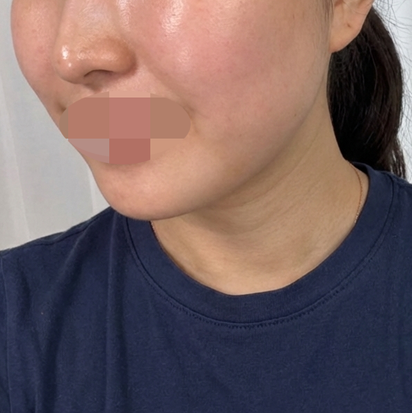 작년에 너무 아파서 올해는 수면 리쥬란으로 받아봤어요~