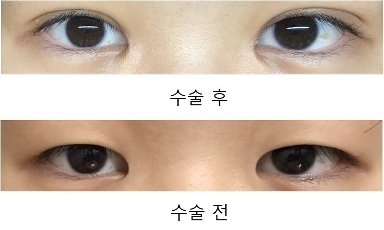눈교, 윗트, 자연유착 추기이이ㅣ