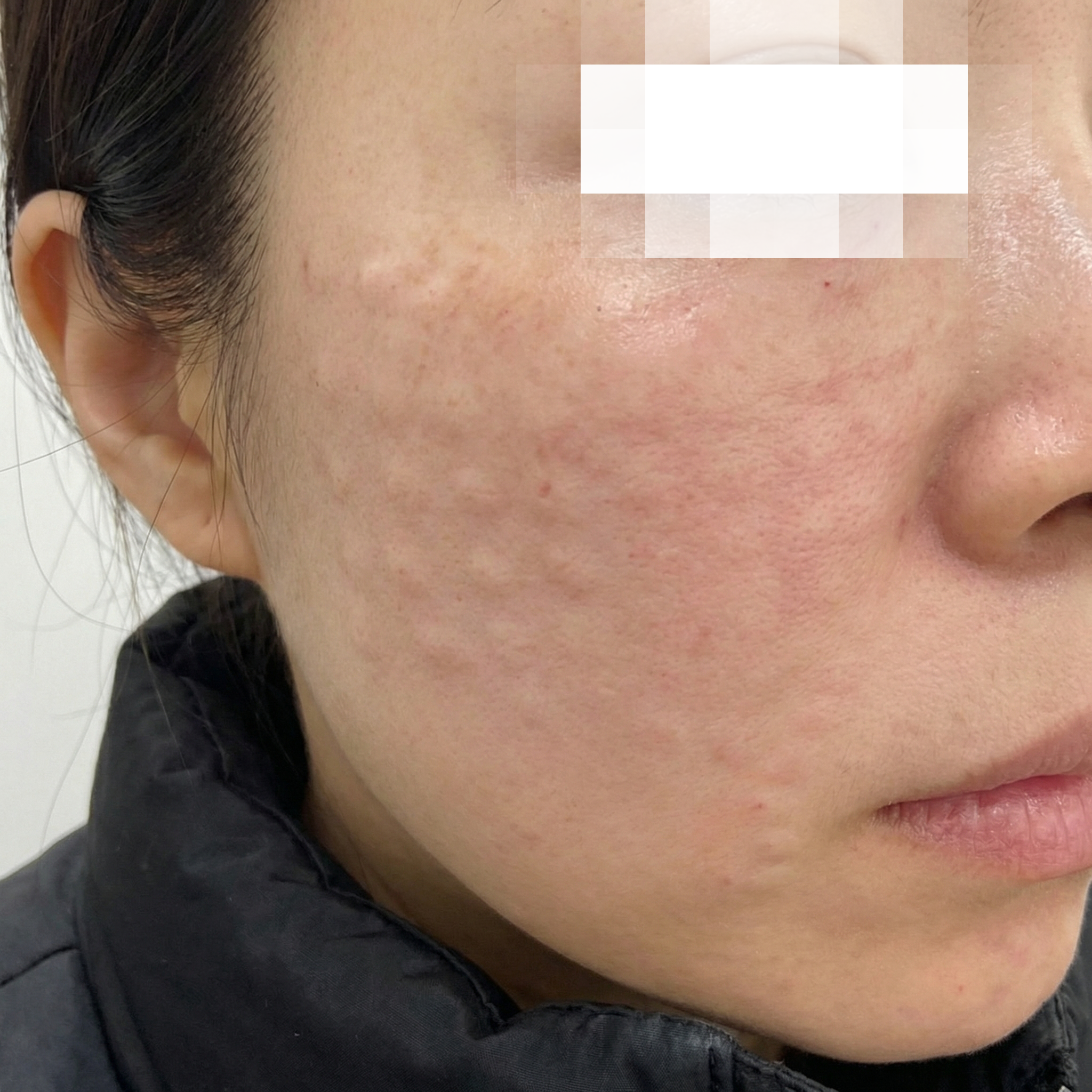 수면 리쥬란 입문했는데, 자고 일어났더니 끝남ㅎㅎ 또 올게요~
