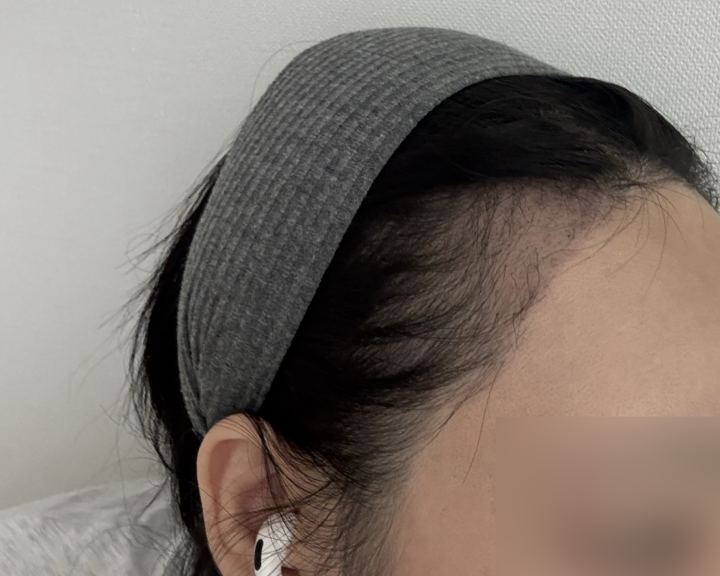 절개 모발이식 3개월 후기, 드디어 채워지는 느낌!