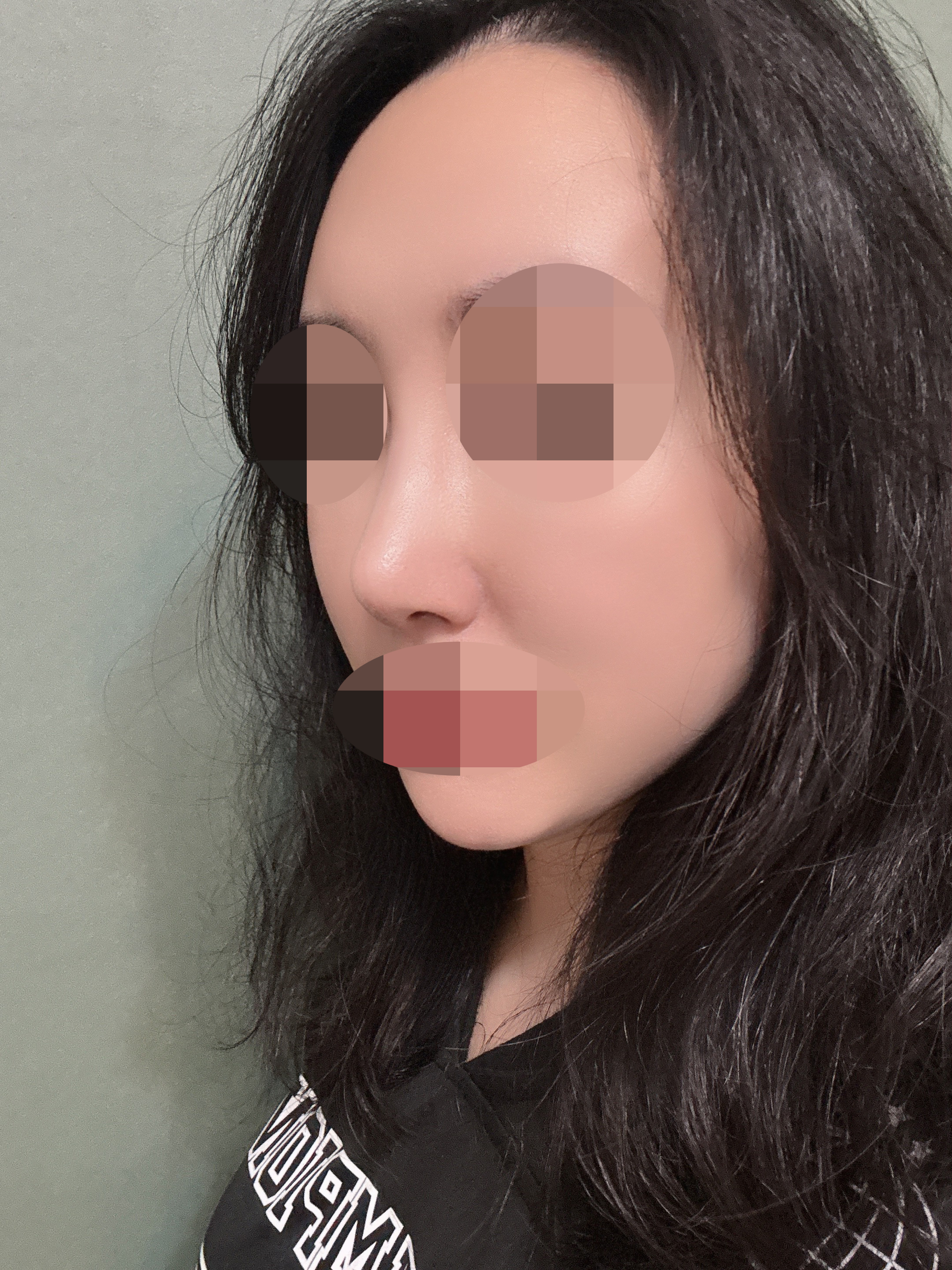코수술 2주차, 자연스럽고 숨쉬기도 편해졌어요