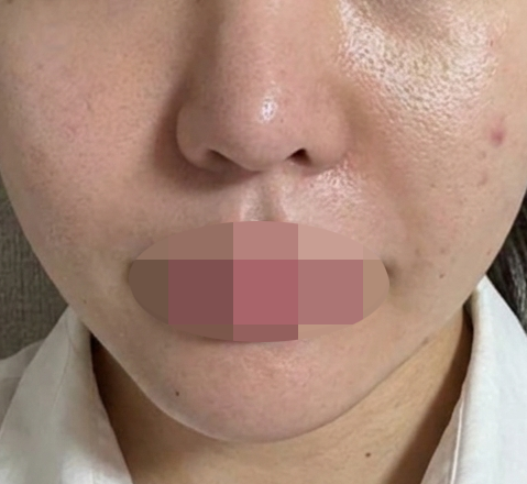 수면으로 편하게 받은 리쥬쎄라, 만족스러워서 추천드려요ㅎㅎ
