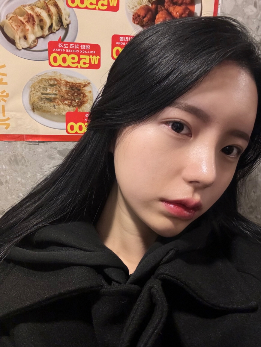 주변에서도 코 너무 잘됐다고 소개시켜달라고 했어요!!앞모습도 오똑해져서 넘 좋습니당