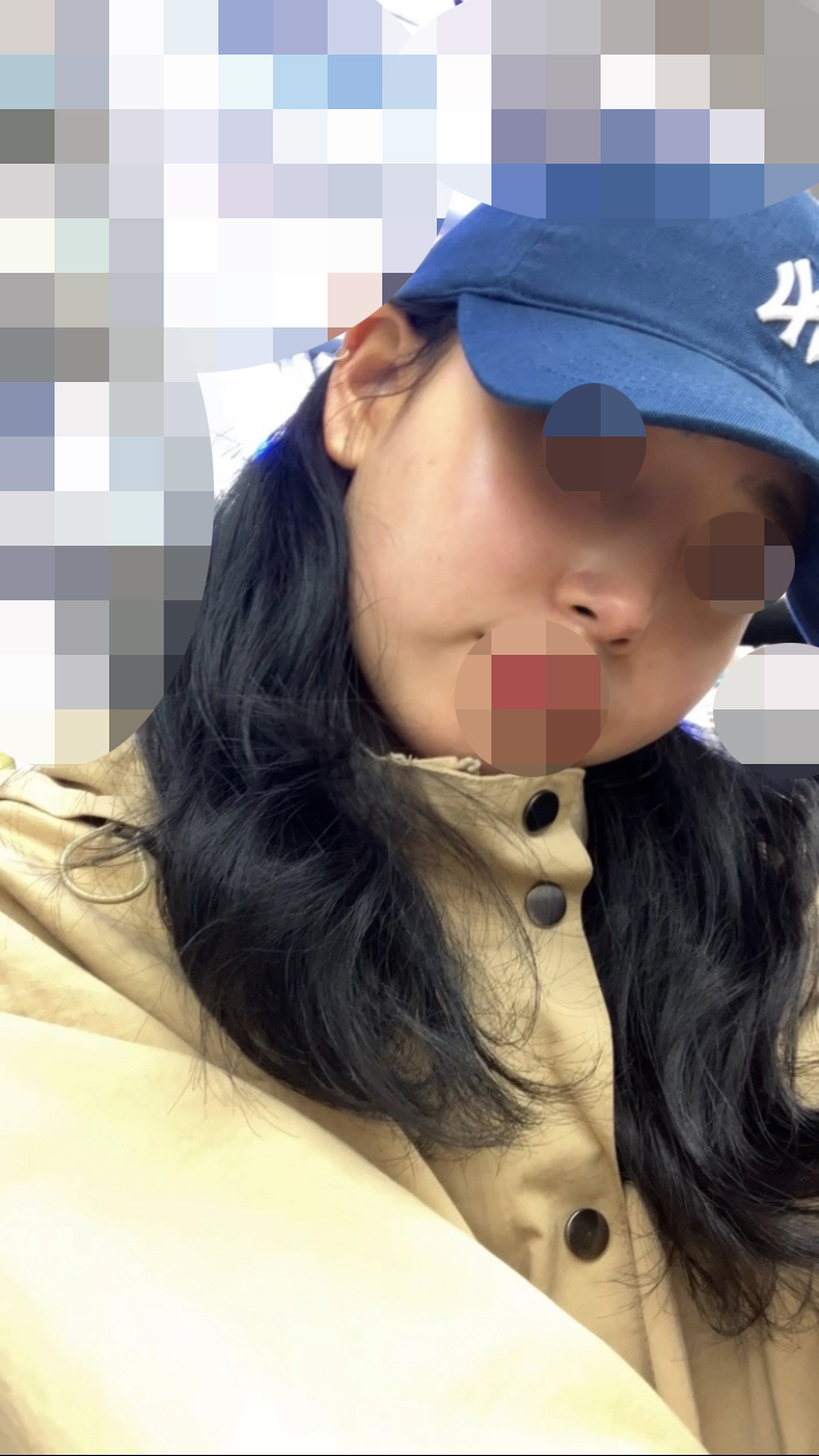 세달차인 만큼 이제 생활에 제한도 없고 피부과시술도 할 수 있고 수영장도 다닐만큼 많이 자연스러워졌습니다!