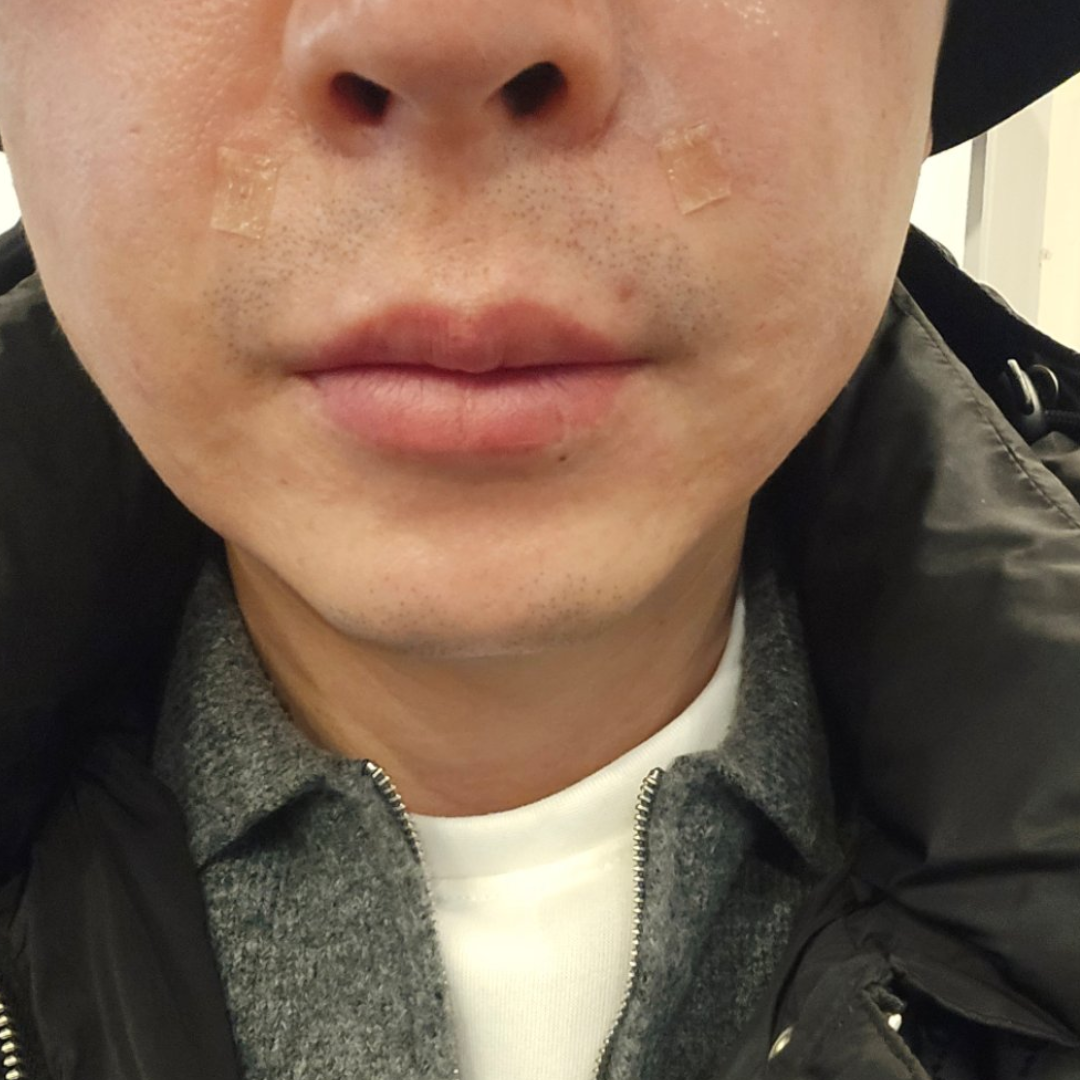 잔주름이랑 탄력 고민에 샤넬주사 받았는데 꼼꼼하게 잘해주셨어요