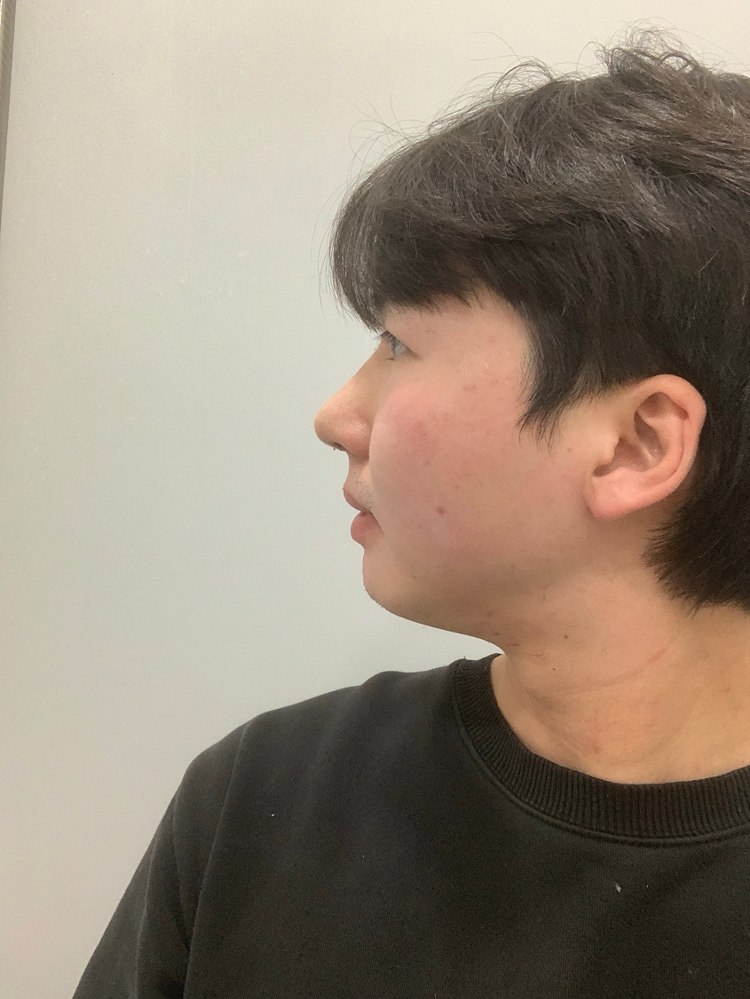 코끝이랑 메부리코교정 및 흰코 교정 진행했어요