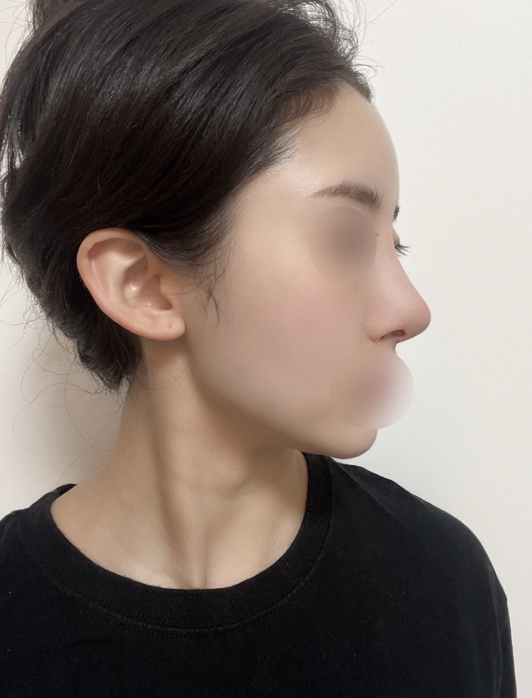 코수술 했어요!