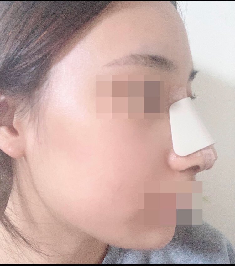 매부리 수술후기