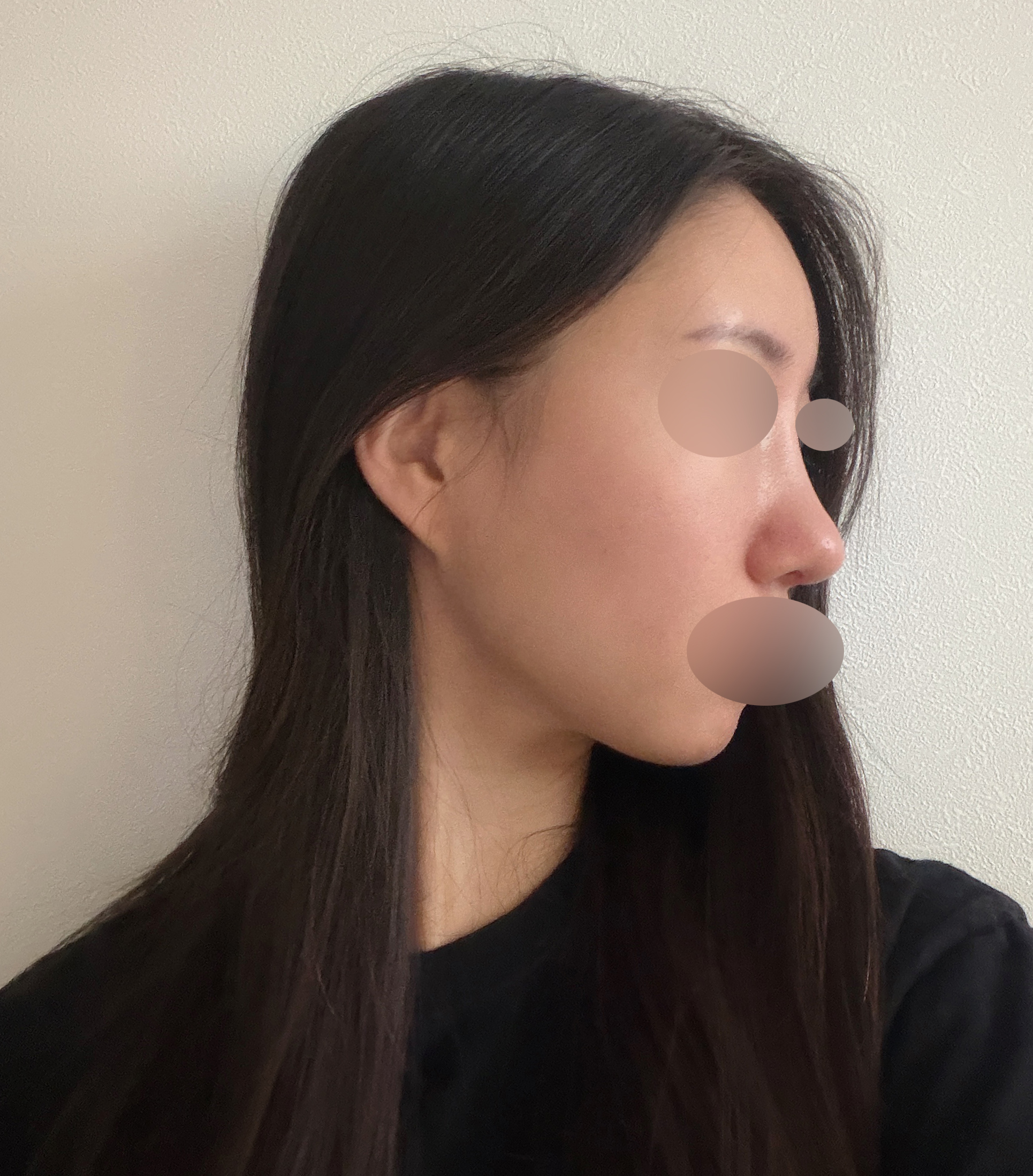코재수술 후 한 달, 원하는 라인으로 자리 잡는 중이에요 :)