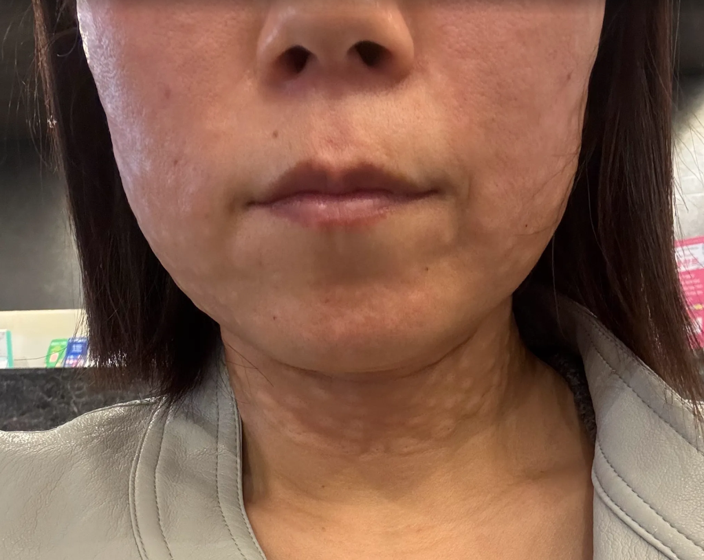 수면 리쥬란 받았는데 아프지 않고 친절해서 물광 피부 기대돼요 ㅎㅎ