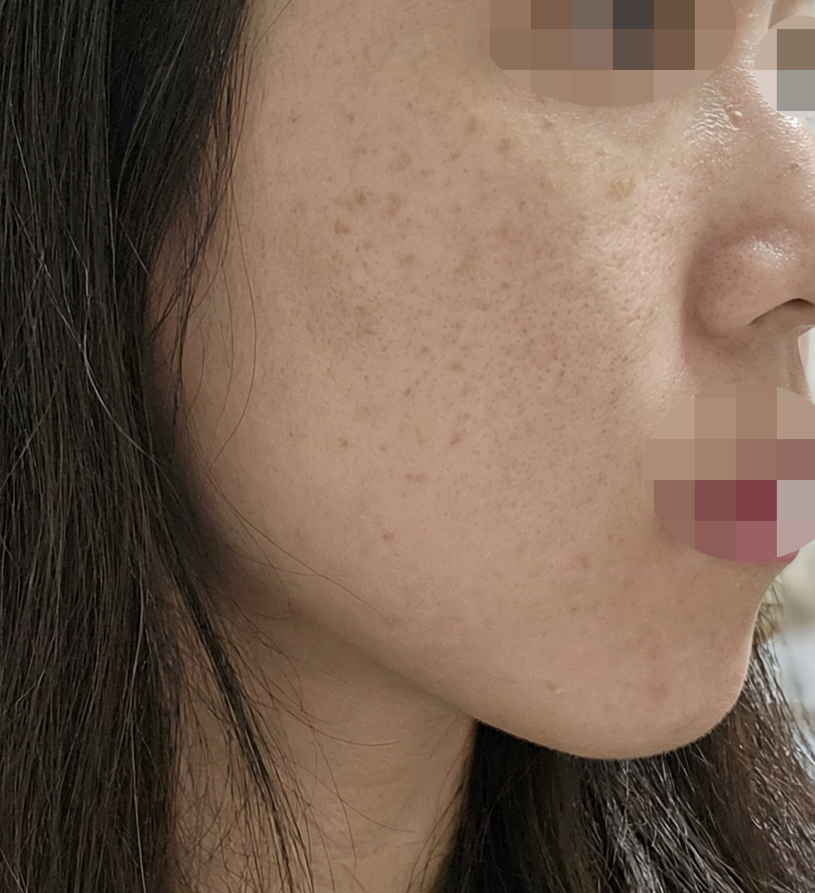 써마지 600샷 처음인데 바로 팔자주름 옅어져서 신기해요 ㅎㅎ