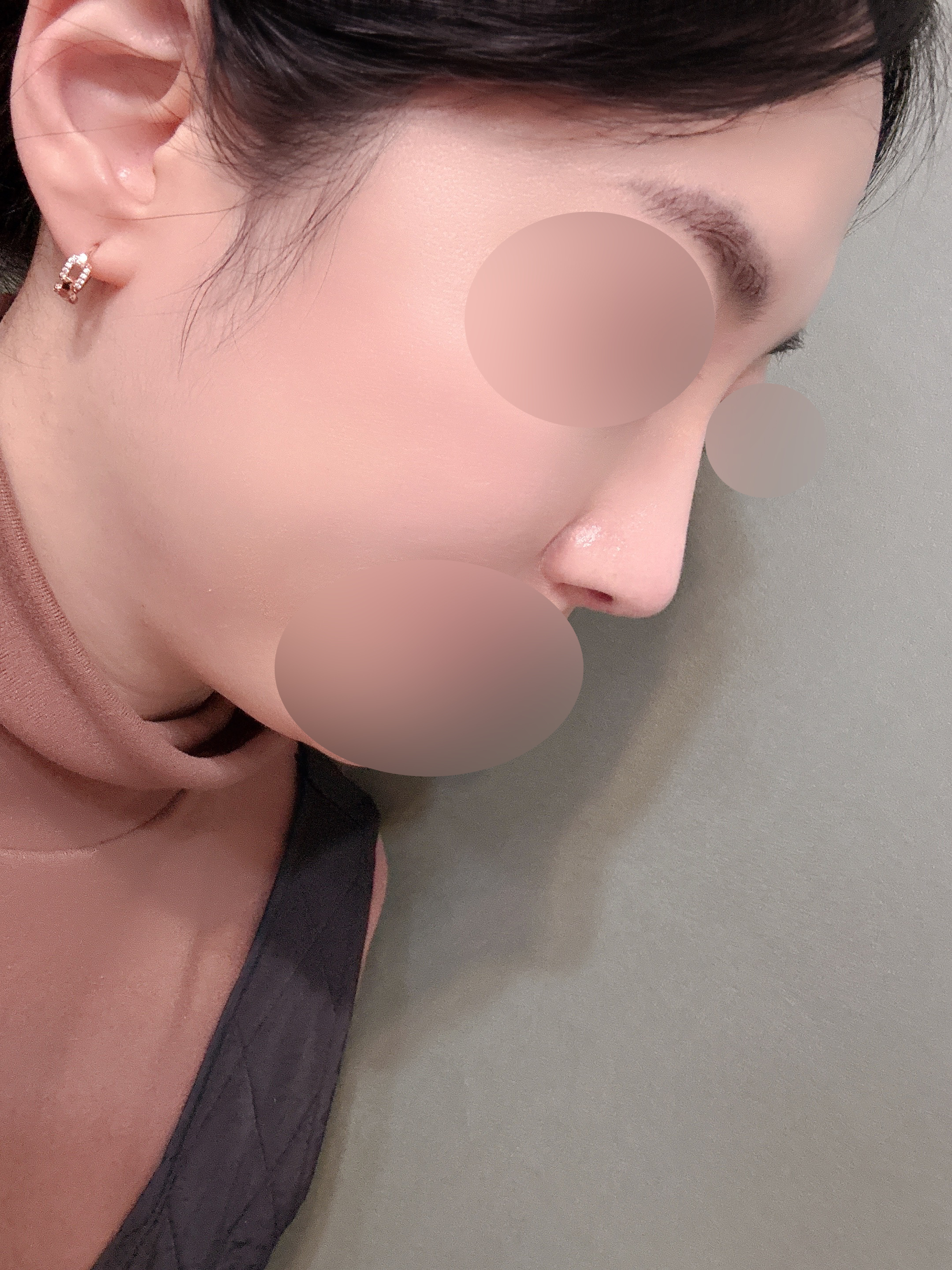 코성형 후 4개월, 정말 하길 잘한 수술이에요