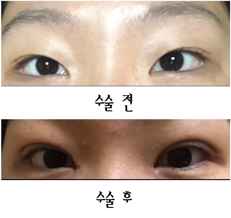 쌍수 한달차!!