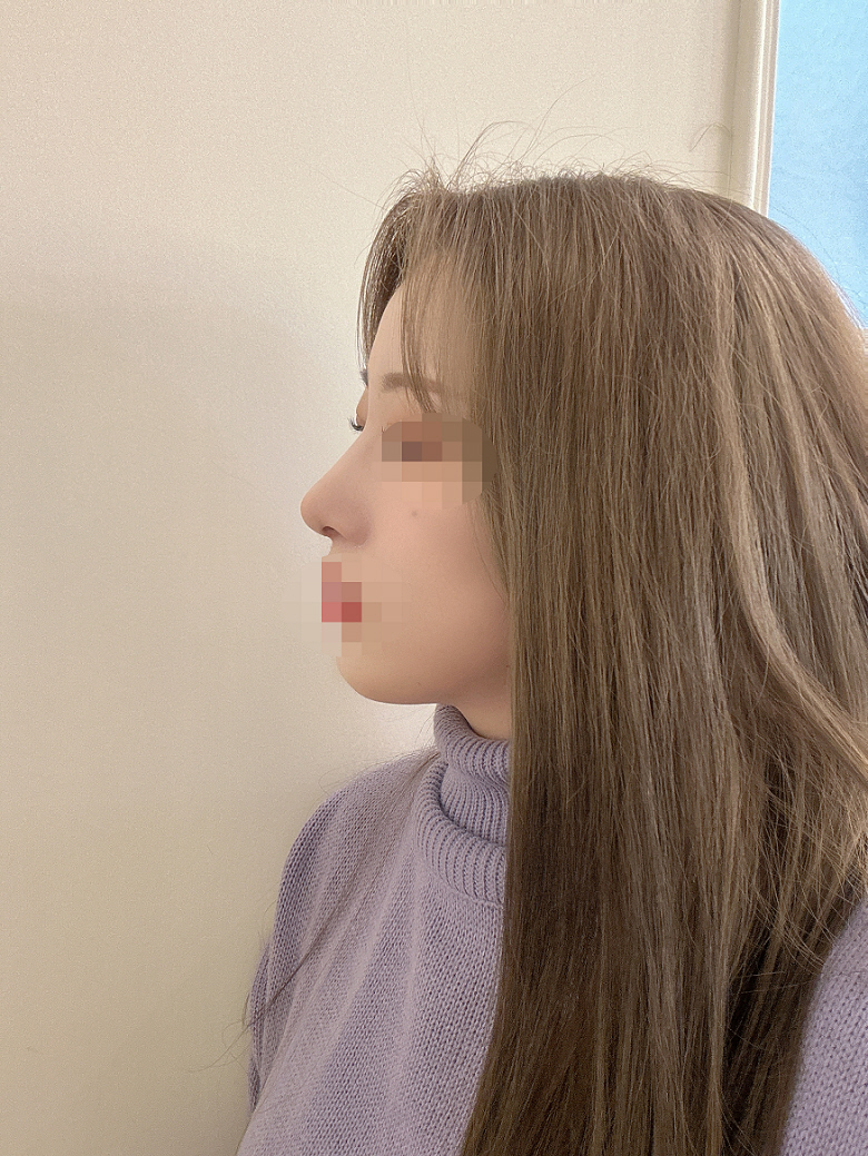 붓기도 잘 빠지구 있고 좋은 수술받아서 너무 감사해오ᅲᅲ