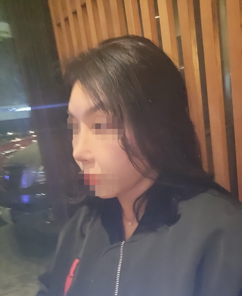 서울아이성형외과서 코 재수술 받은지 벌써 2달 되었습니다