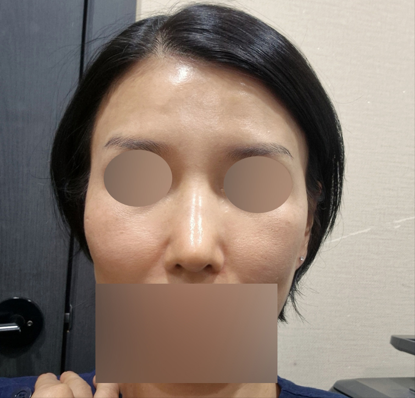 복코 수술 2주차, 초기지만 달라진 느낌 시작