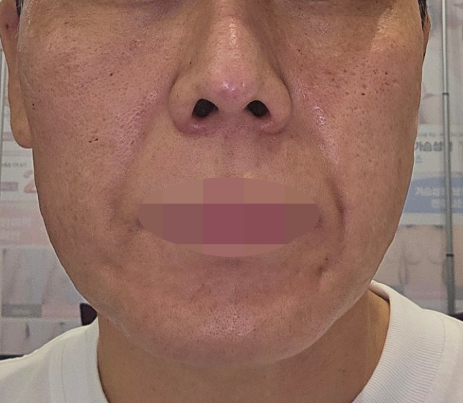 거친 피부이랑 모공 고민으로 쥬베룩 받아봤습니다.