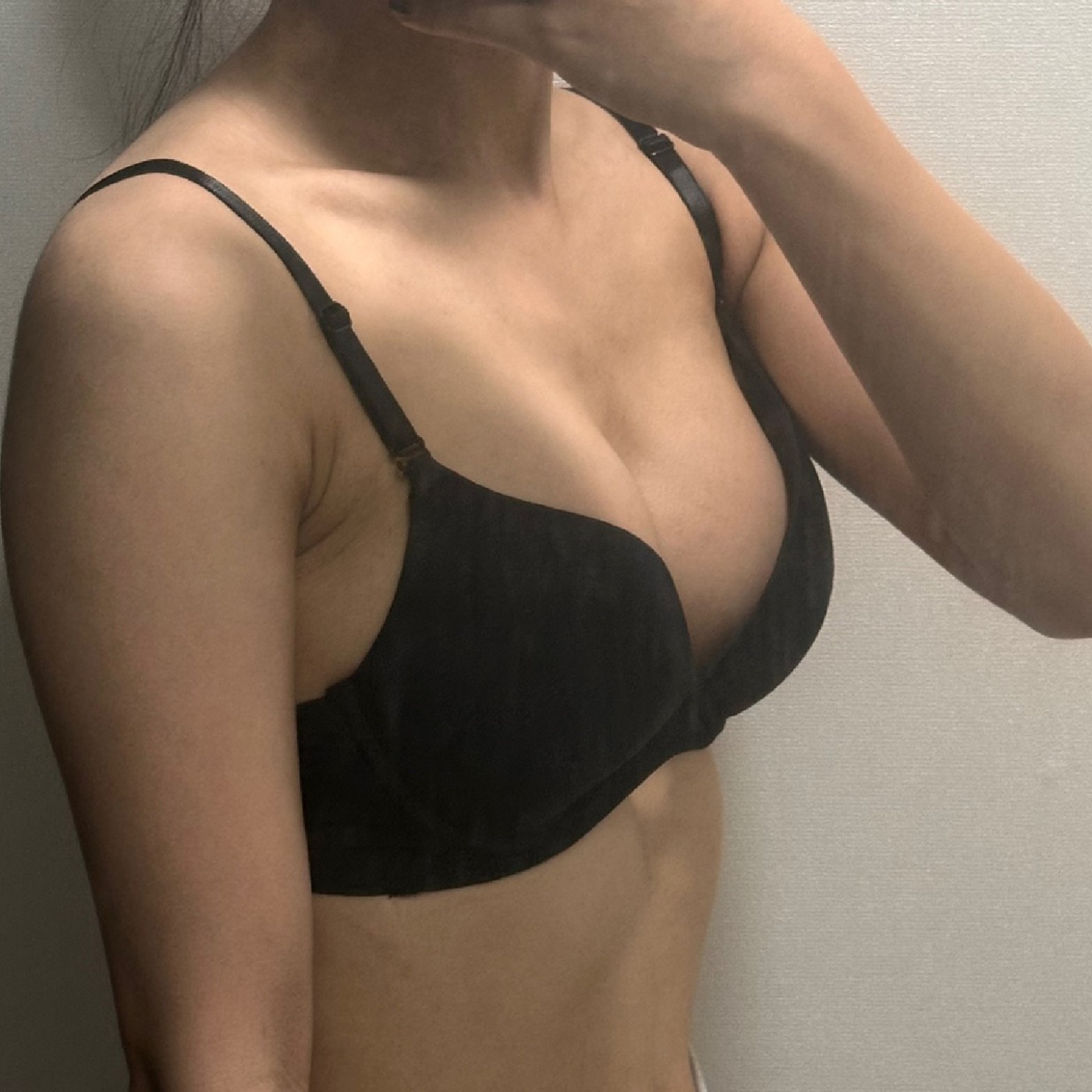 이제 감촉도 부드럽고 자연스러워진 것 같아요! 후회없는 수술이예요!