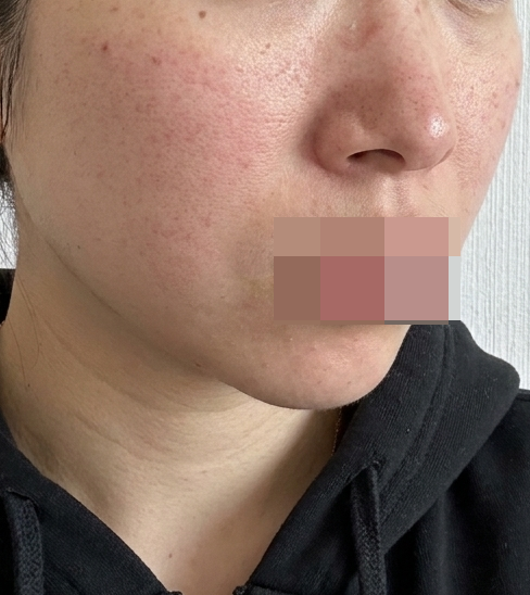 수면으로 아픔 없이! 한 번에 관리 가능한 리쥬쎄라 강추예요
